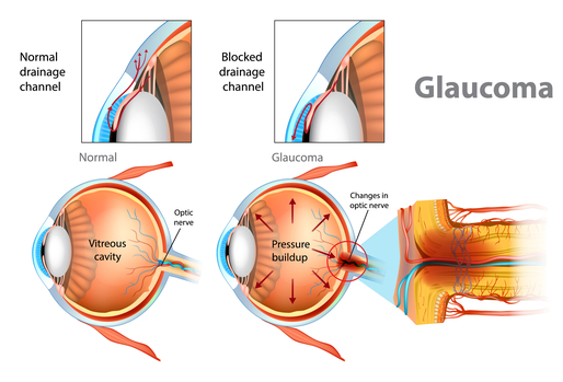 Glaucoma diagram