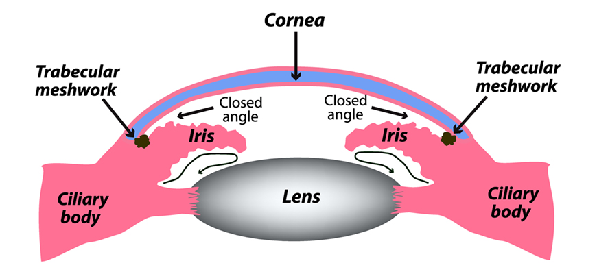 Closed angle Glacucoma diagram