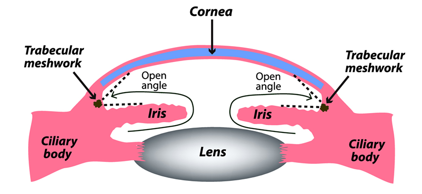Diagram of Open Angle Glaucoma